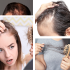 Caída de Cabello o Alopecia, Plasma rico en plaquetas – 3 Sesiones